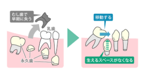 乳歯の虫歯リスク
