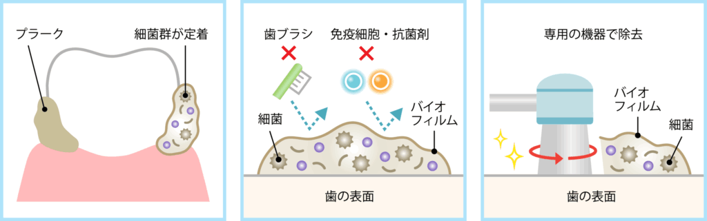 歯の表面についてプラークがバイオフィルムを形成する仕組み