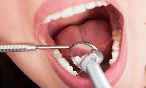 虫歯の主な治療法