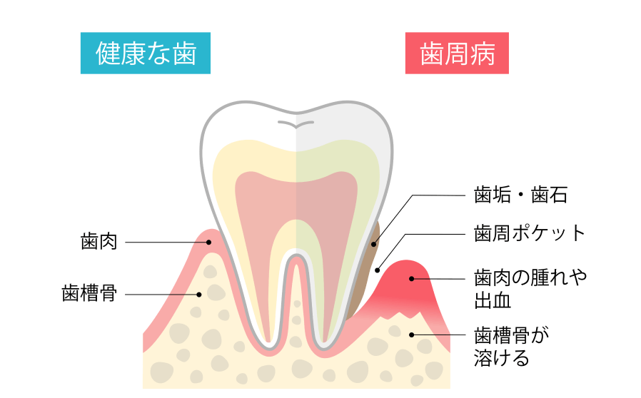 歯周病の主な治療法