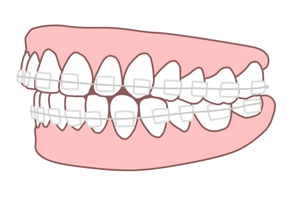矯正後の後戻り 1