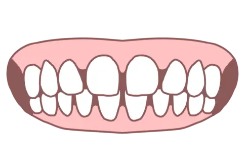 空隙歯列